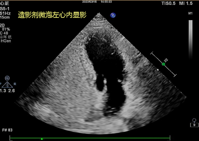 造影剂微泡左心内显影（.png